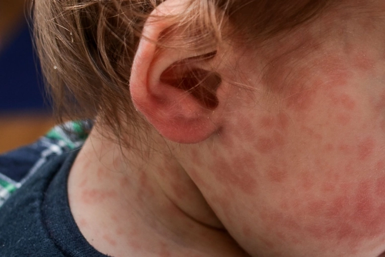 Se confirm&oacute; un caso de sarampi&oacute;n en la provincia de Entre R&iacute;os